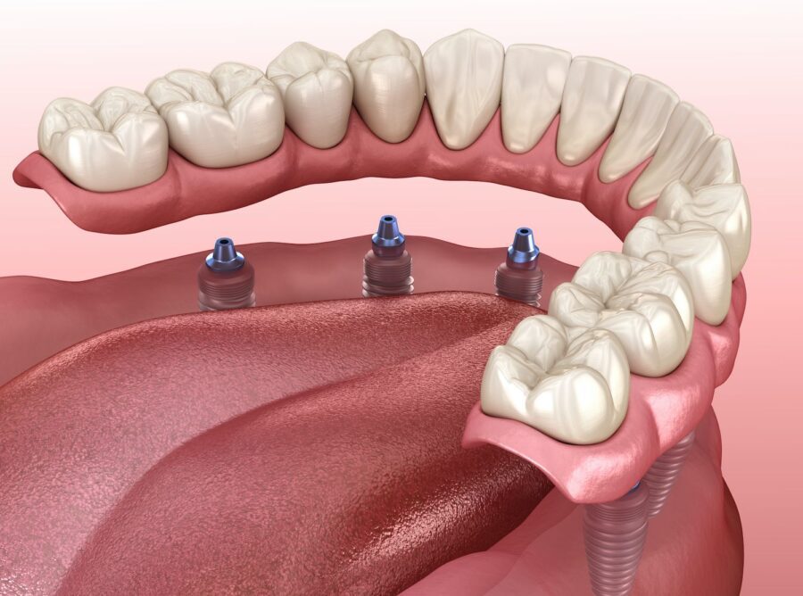 How To Prevent Dental Implant Failure Dentist In Payette ID